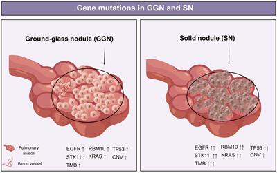 Multidimensional biological characteristics of ground glass nodules